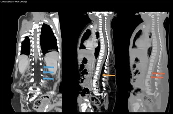 Penn Global Health 2021 Imaging Case Competition: Mzati Chikalipo presentation slide, spine imaging